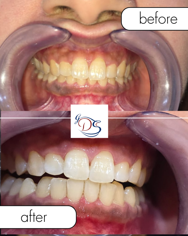 beige minimalist beauty before after collage instagram post 3