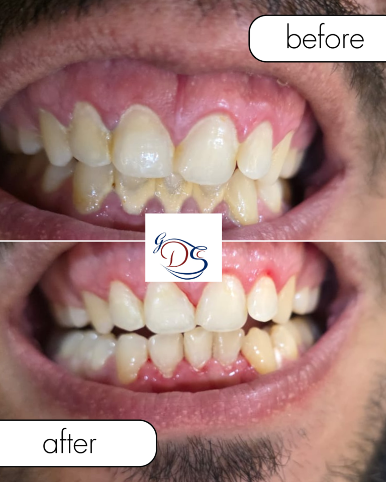 beige minimalist beauty before after collage instagram post 5