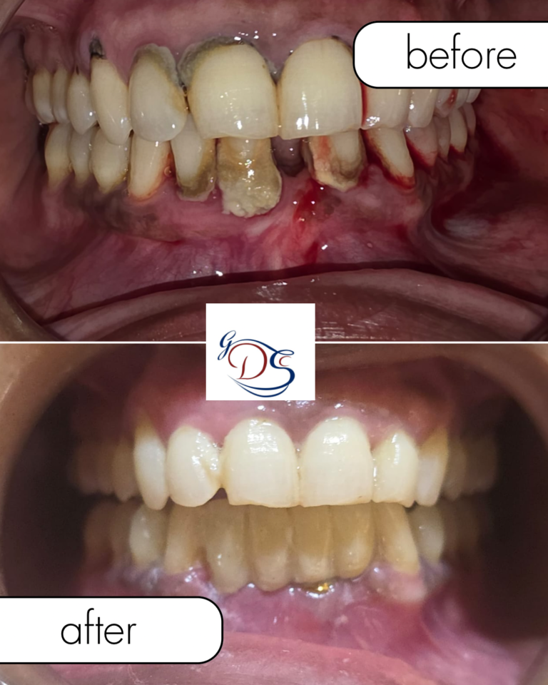 beige minimalist beauty before after collage instagram post