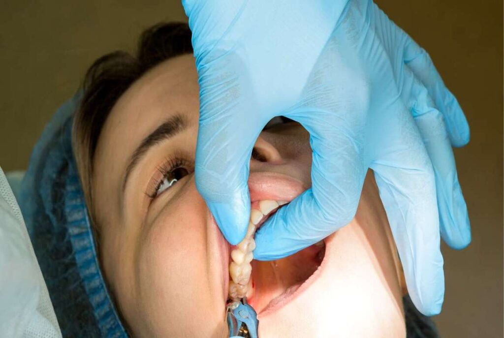 tooth extraction in pune 1
